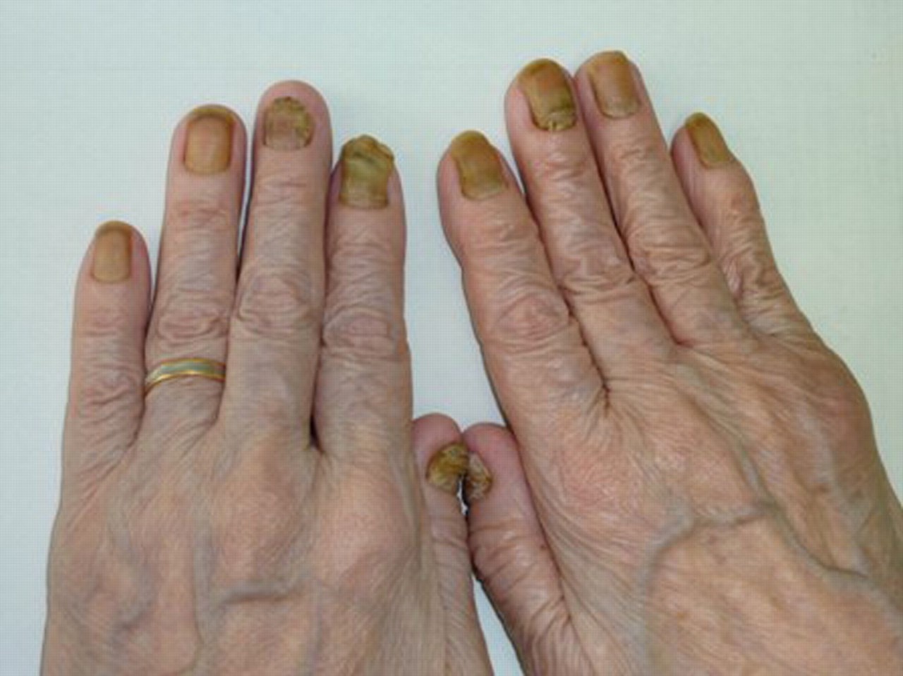 تشخیص سلامت بدن از روی ناخن به ما کمک می‌کند تا دلایل ایجاد سندروم ناخن زرد را بشناسیم.