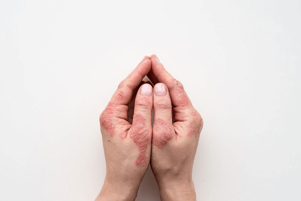 یکی از راه‌های درمان اگزما مرطوب‌ نگه داشتن مداوم پوست دست برای کاهش التهاب‌های آن است