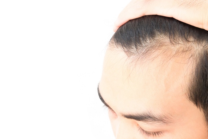 عامل ریزش مو و درمان آن