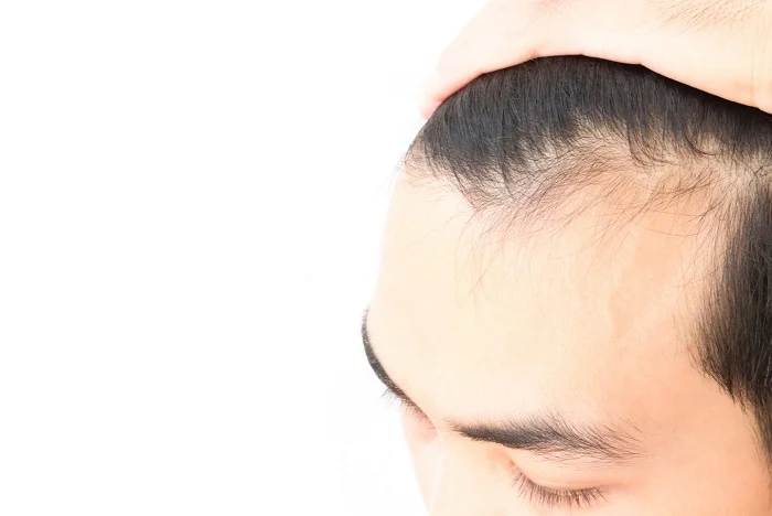 عامل ریزش مو و درمان آن