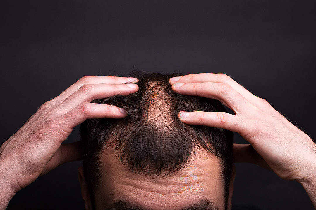 ۲۱ عامل اصلی ریزش مو و درمان آن 