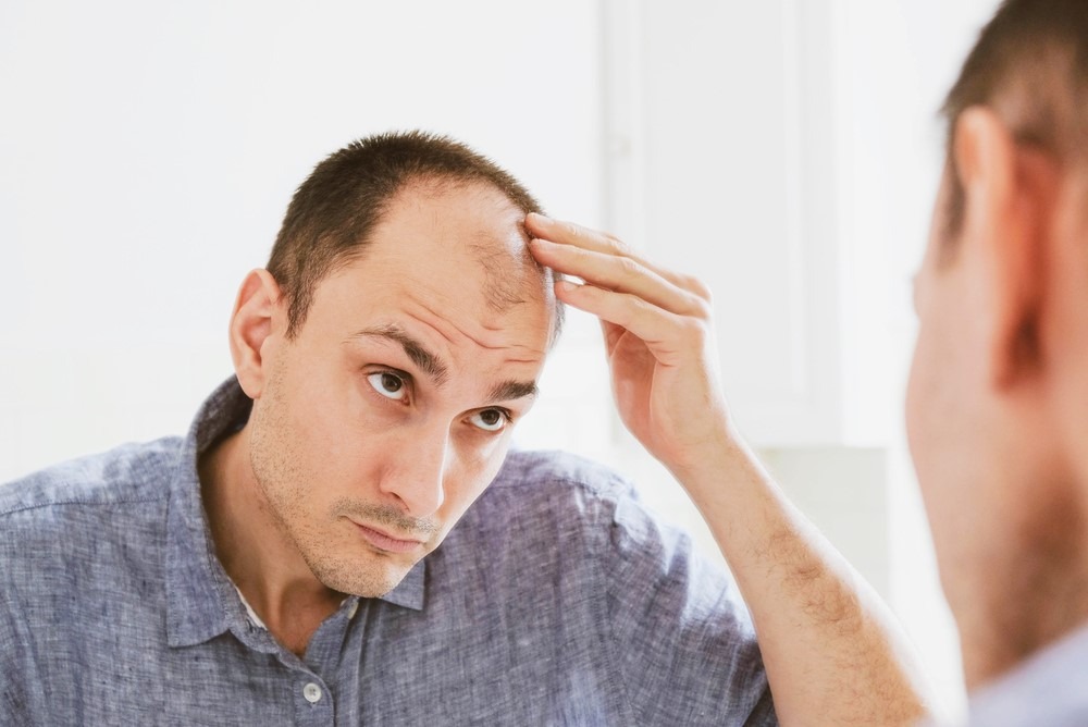 علت ریزش مو در مردان معمولا به‌دلیل عوامل ارثی است و این ریزش مو از ناحیه شقیقه‌ها شروع می‌شود