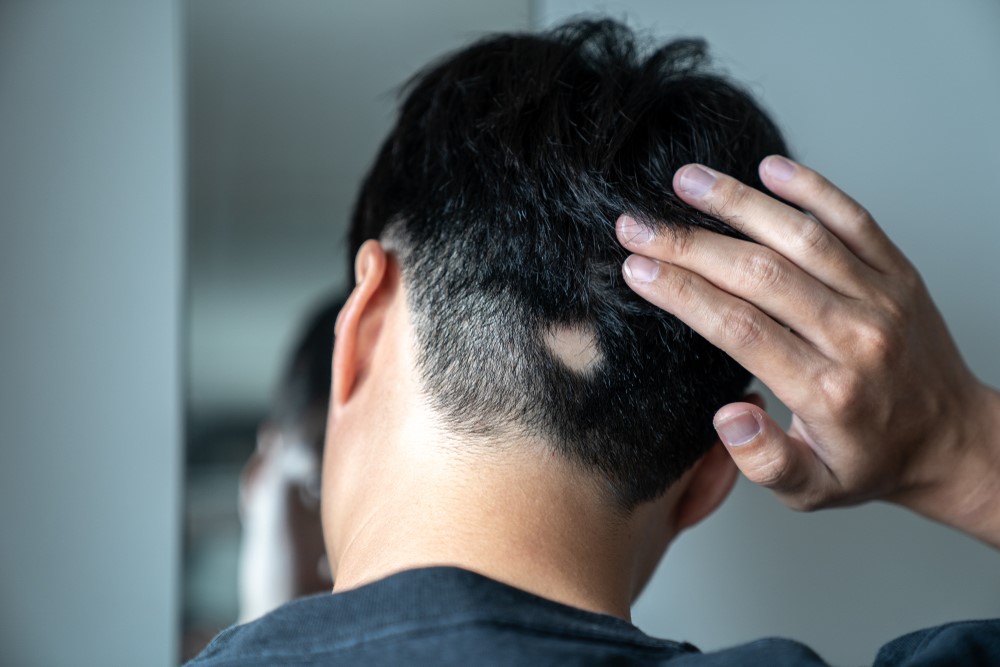 بیماری آلوپسی آره آتا، مرتبط با سیستم ایمنی و عصبی است و علت ریزش مو سکه‌ای در زنان و مردان است.